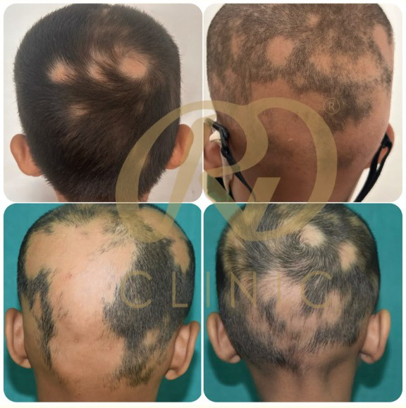 Advanced Treatment for Children with Alopecia Areata
