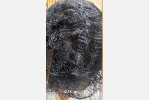 Hair Loss Treatment — after