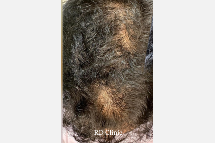 Hair Loss Treatment — before