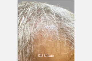 Hair Loss Treatment — after