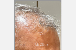 Hair Loss Treatment — before