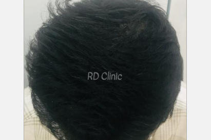 Hair Loss Treatment — after