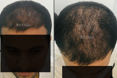 Hair Loss Treatment — before