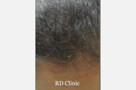 Hair Loss Treatment — after