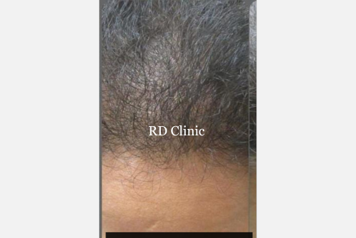 Hair Loss Treatment — before