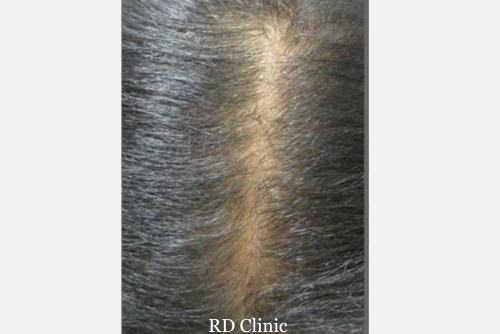 Hair Loss Treatment — after