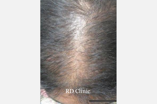 Hair Loss Treatment — before