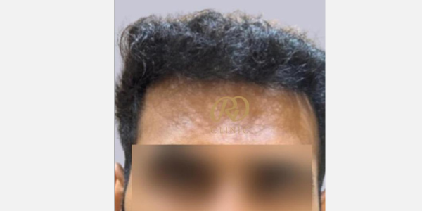 Hair Loss Treatment — after