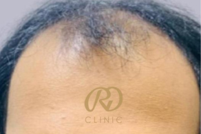 Hair Loss Treatment — before