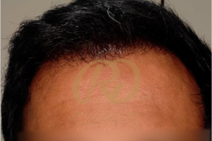 Hair Loss Treatment — after