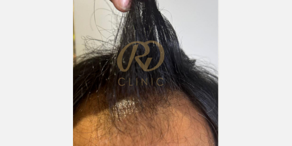 Hair Loss Treatment — before