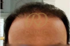 Hair Loss Treatment — after
