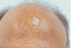 Hair Loss Treatment — before