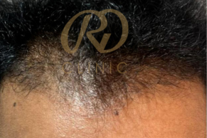 Hair Loss Treatment — before
