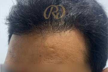 Hair Loss Treatment — after