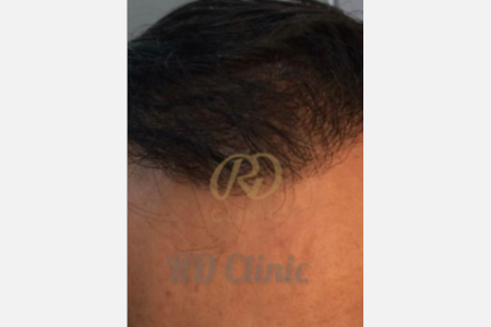 Hair Loss Treatment — after