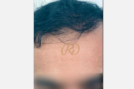 Hair Loss Treatment — after