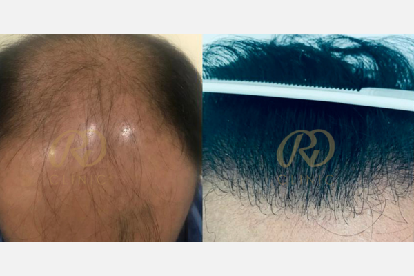 Hair Loss Treatment — before