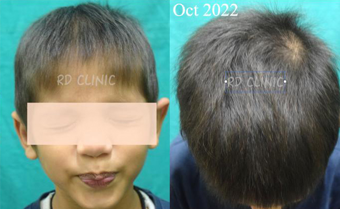 Hair Loss Treatment — after