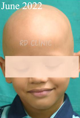 Hair Loss Treatment — before