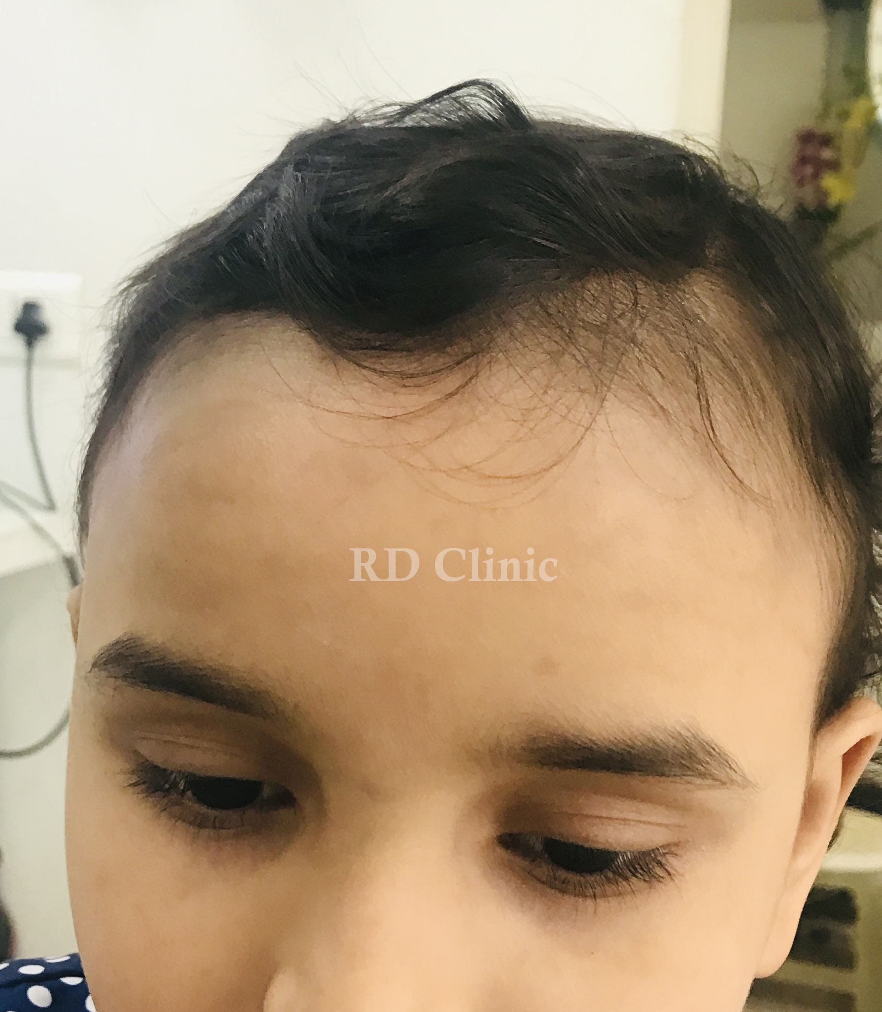 Alopecia Totalis Treatment — after
