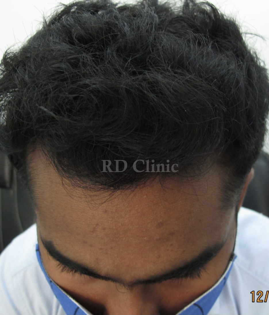 Hair Loss Treatment — after