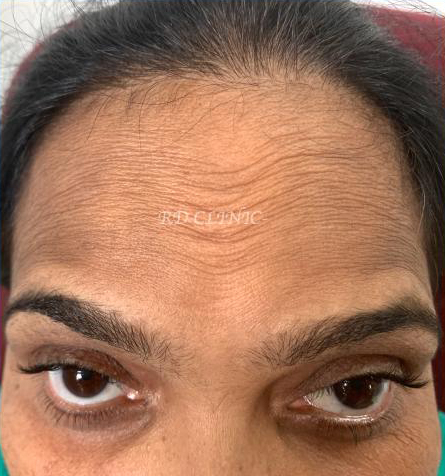 Reduction in forehead wrinkles — before