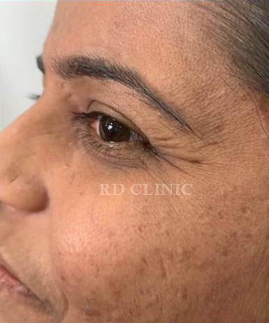 Crowfeet wrinkle reduction — before