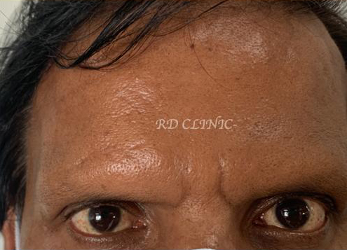 Reduction in forehead wrinkles — after