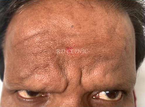 Reduction in forehead wrinkles — before