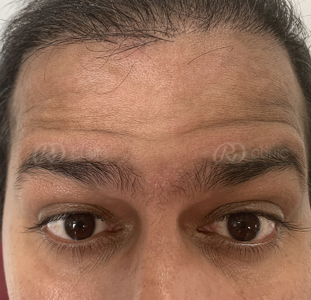 Crowfeet wrinkle reduction — before