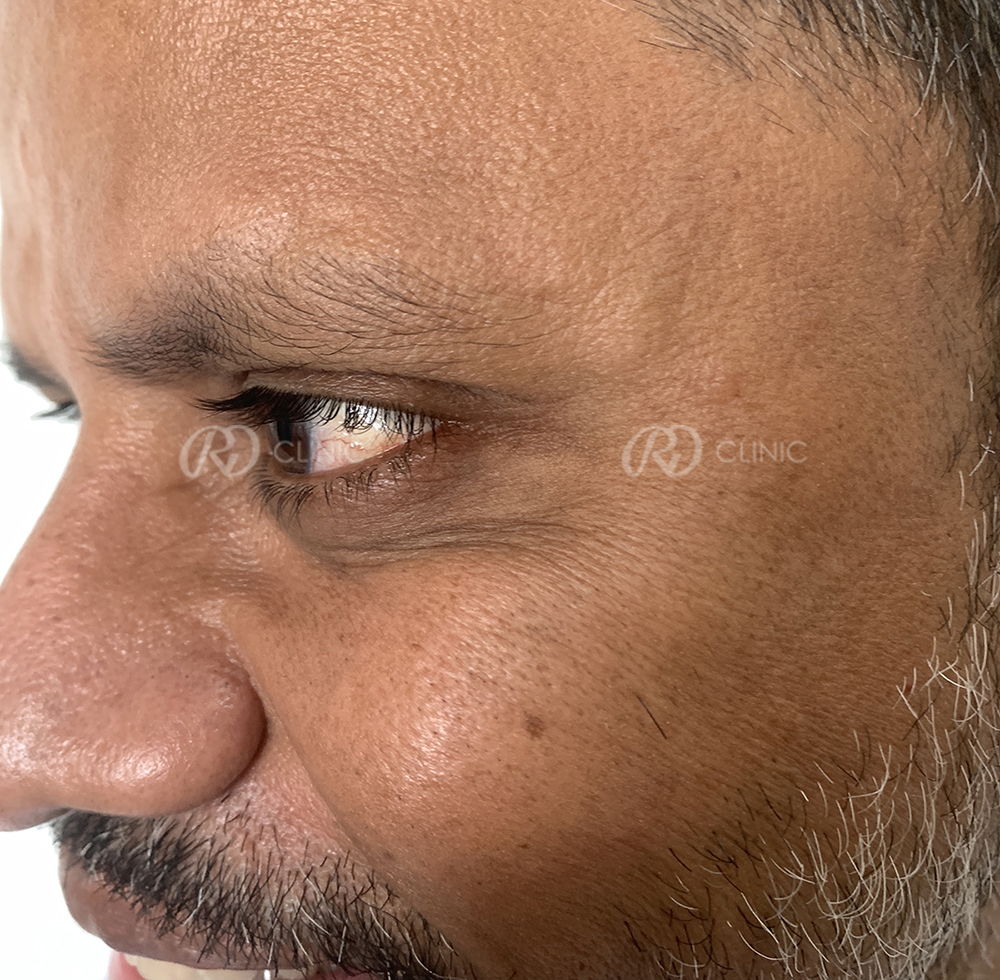 Reduction in forehead wrinkles — after