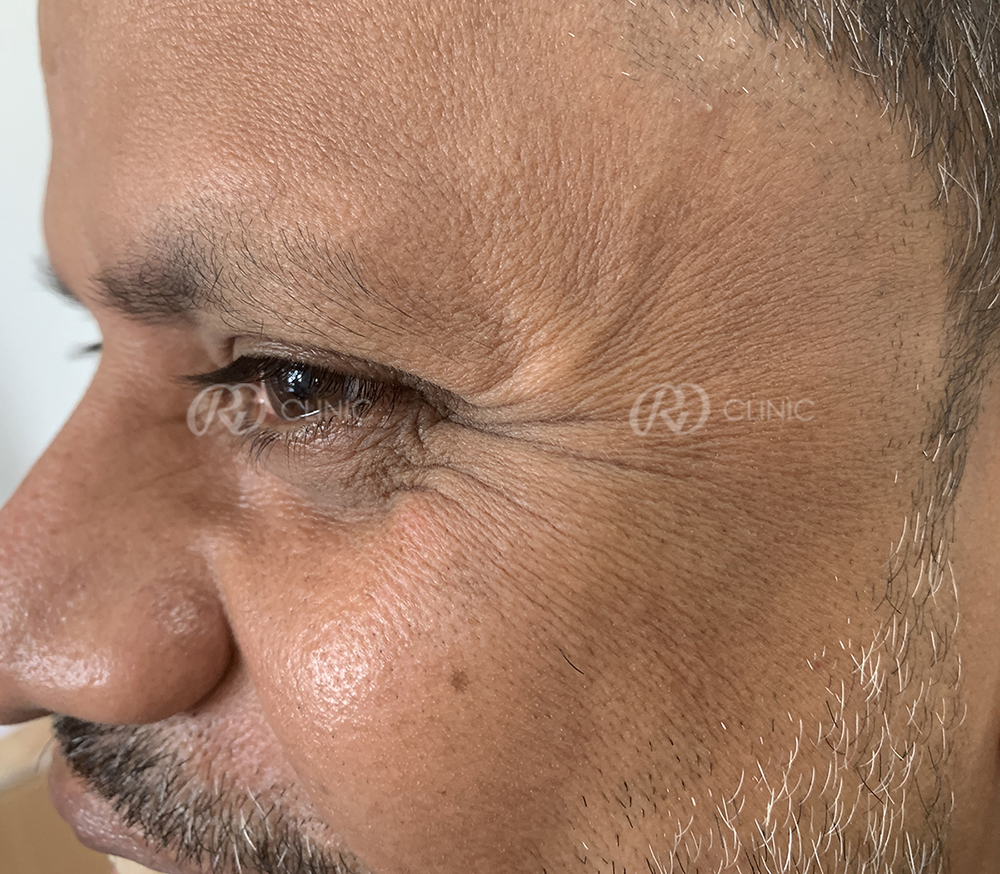 Reduction in forehead wrinkles — before