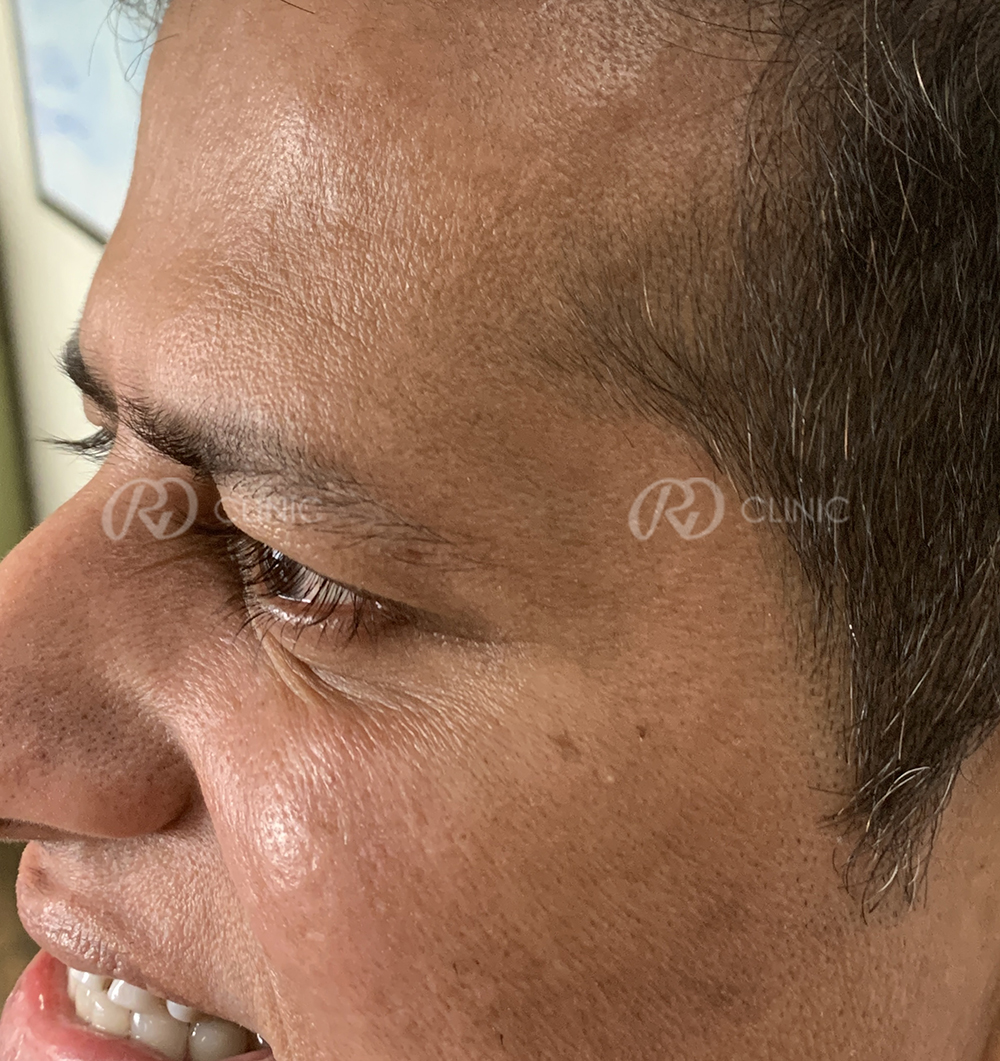 Crowfeet wrinkle reduction — after