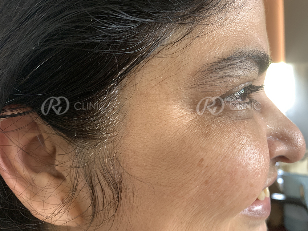 Crowfeet wrinkle reduction — after