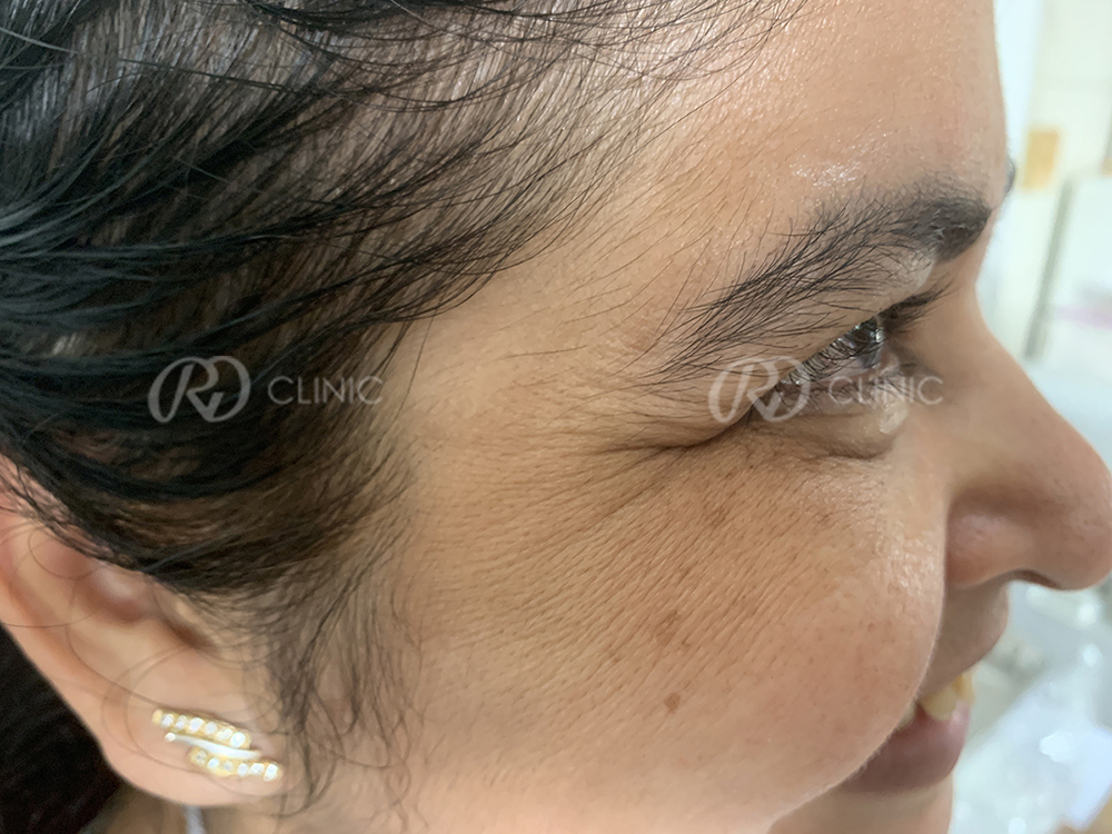 Crowfeet wrinkle reduction — before