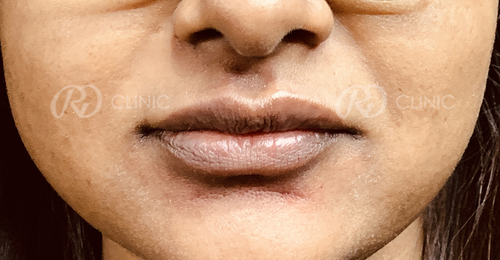 Lip augmentation with filler — after
