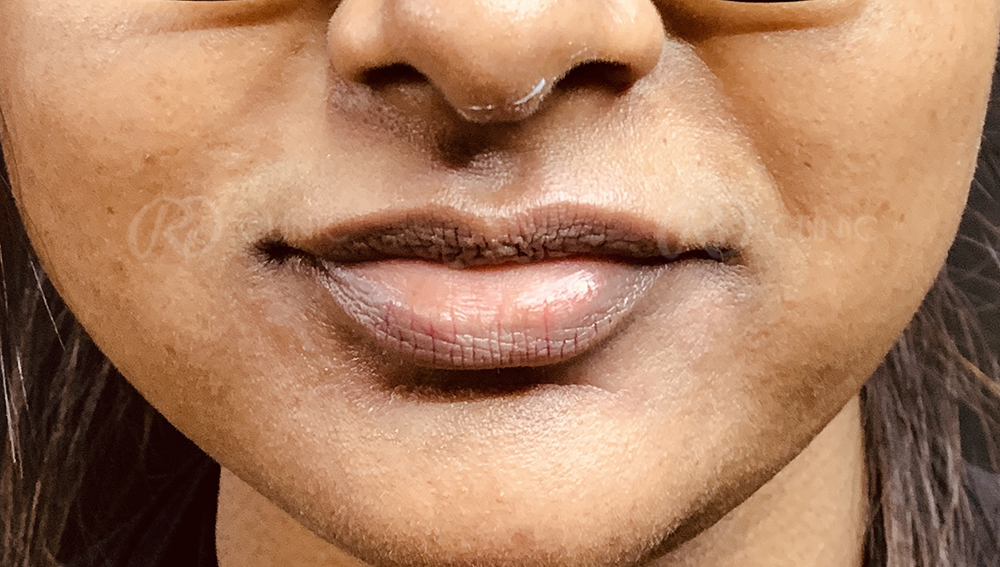Lip augmentation with filler — before