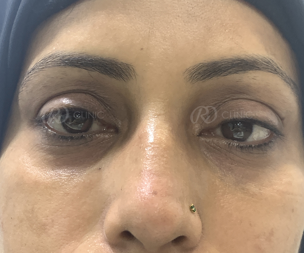 Tear trough correction with filler — after
