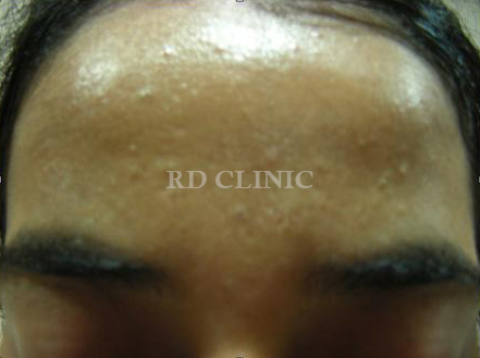 Acne Treatment — after