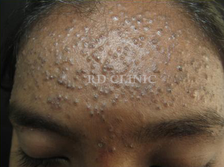 Acne Treatment — before