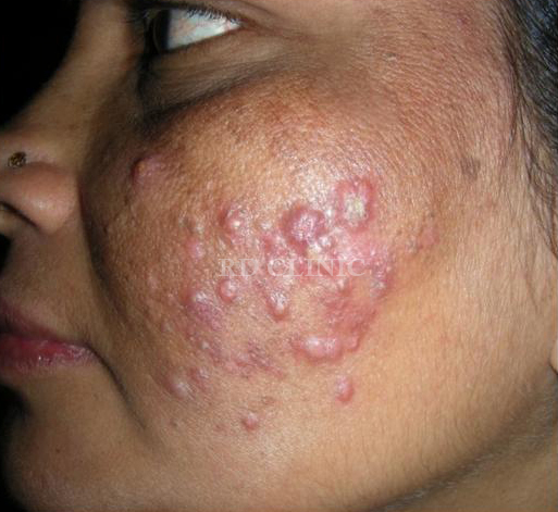Acne Treatment — before