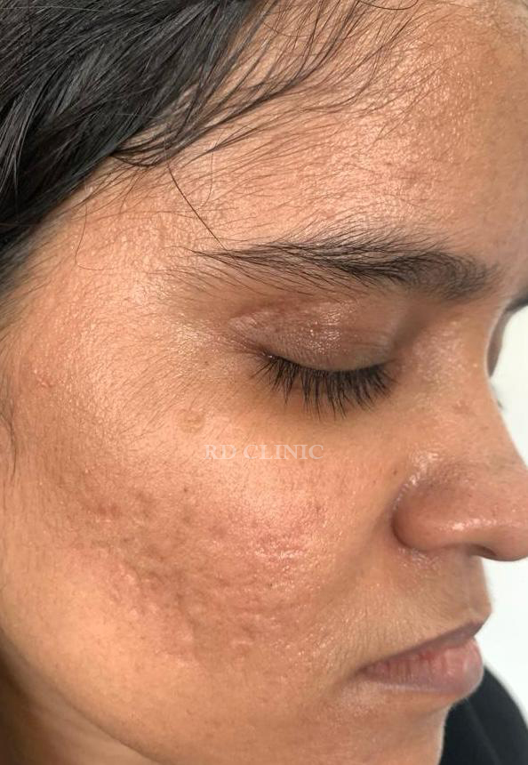 Acne Treatment — after