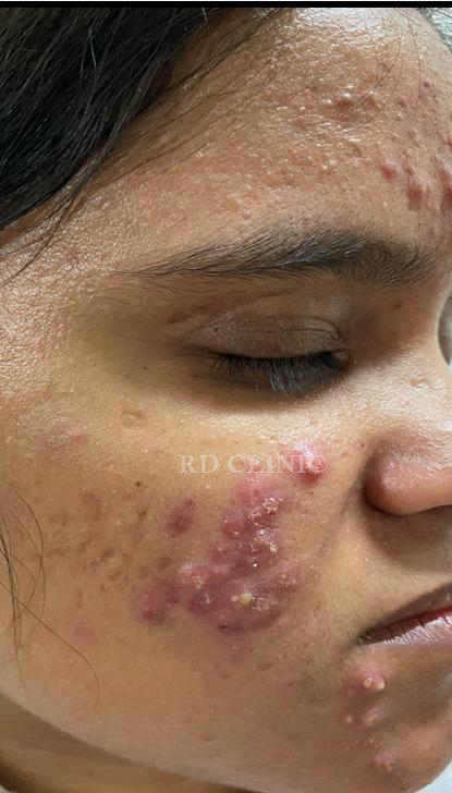 Acne Treatment — before