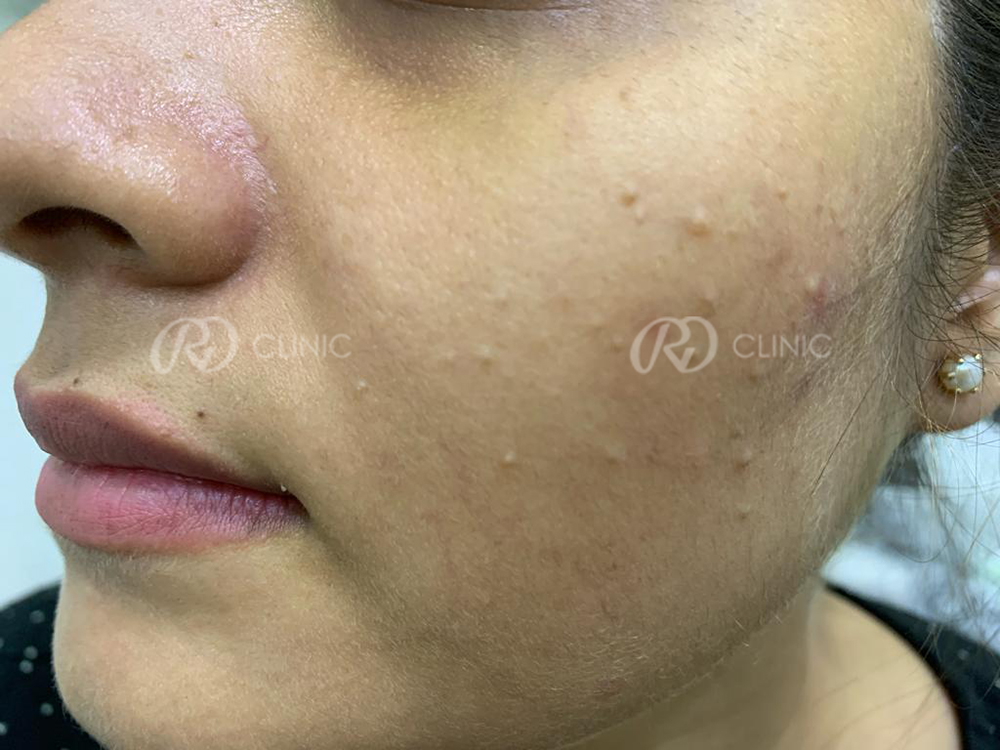 Comedone Removal — before