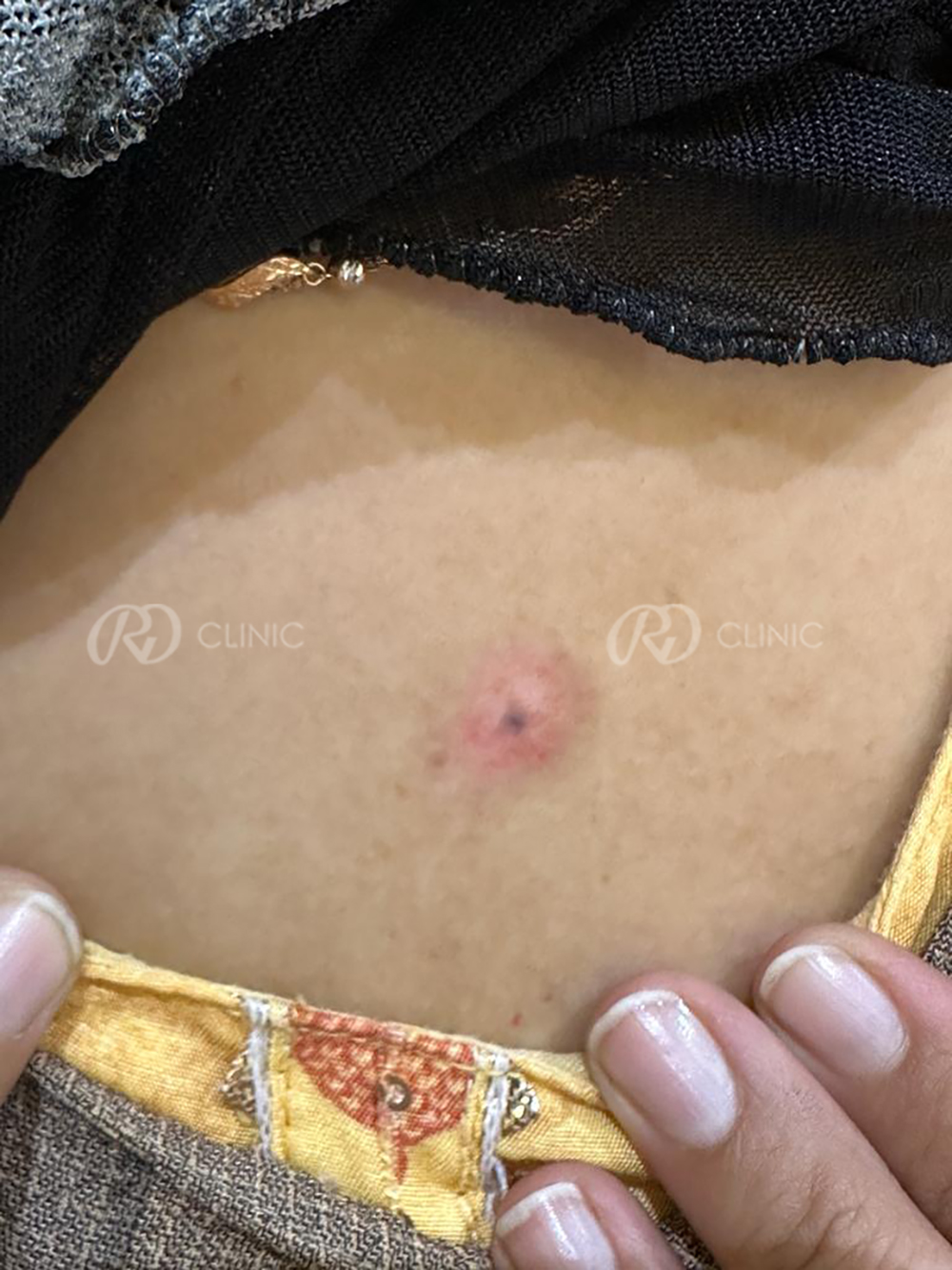 Skin tumour removal without stitches — after