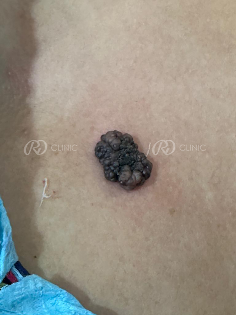 Skin tumour removal without stitches — before