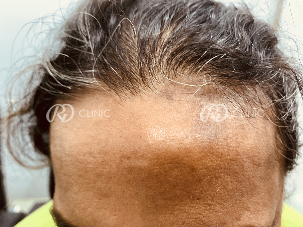 Skin Treatment: Response with melanocytes transfer — after