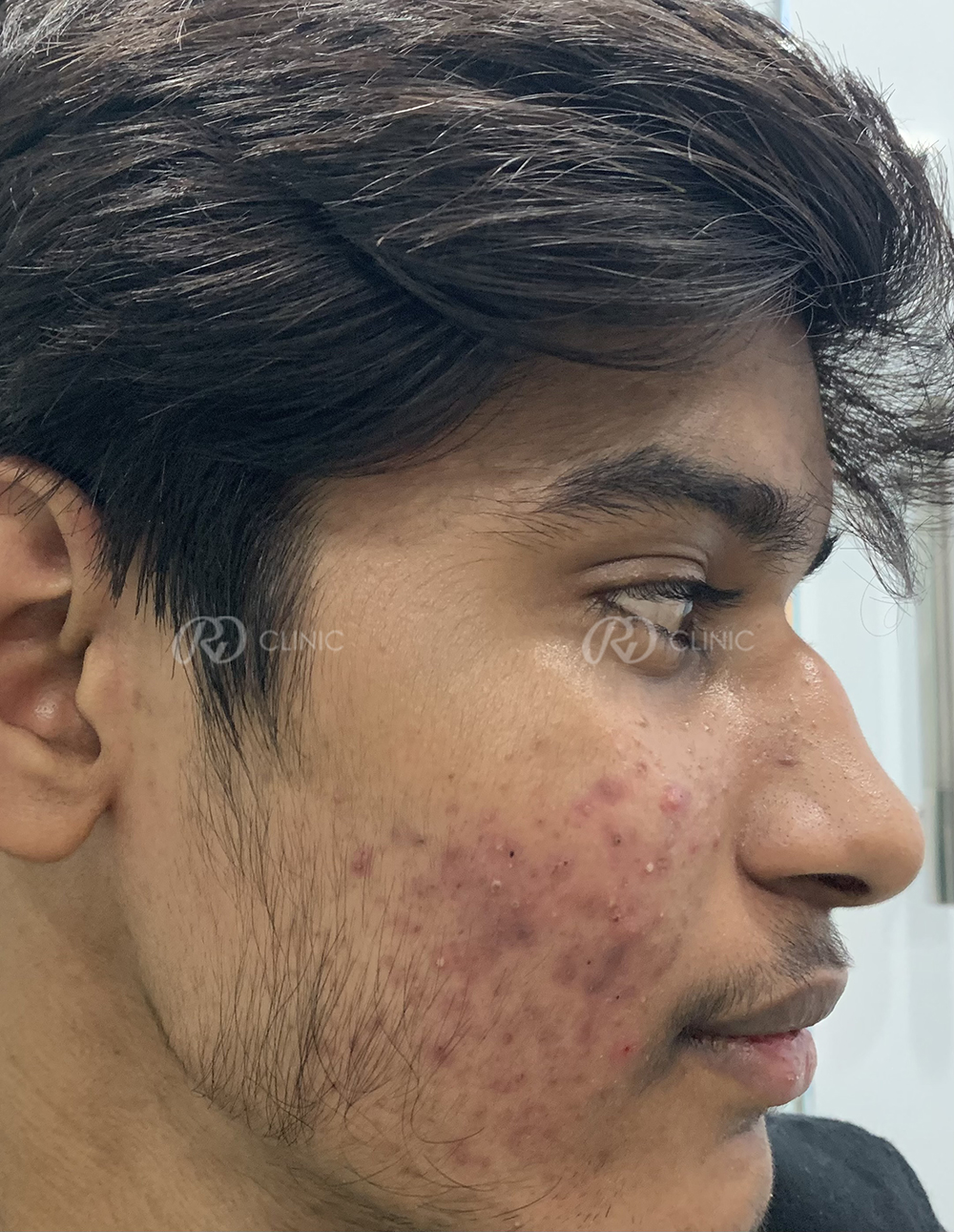 Acne Treatment — before