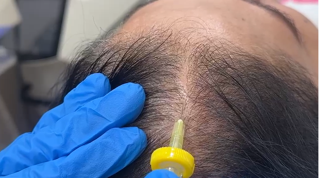 Follicular O₂ Boost Therapy at RD Clinic